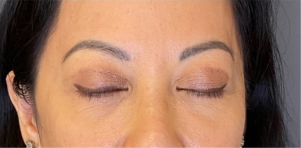 Eyelid Tuck