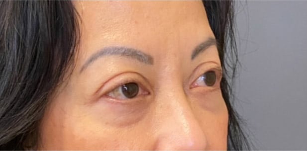 Eyelid Tuck