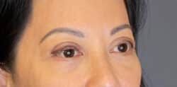 Eyelid Tuck