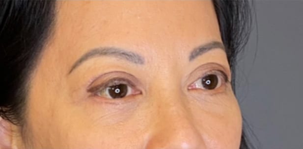 Eyelid Tuck