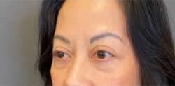 Eyelid Tuck