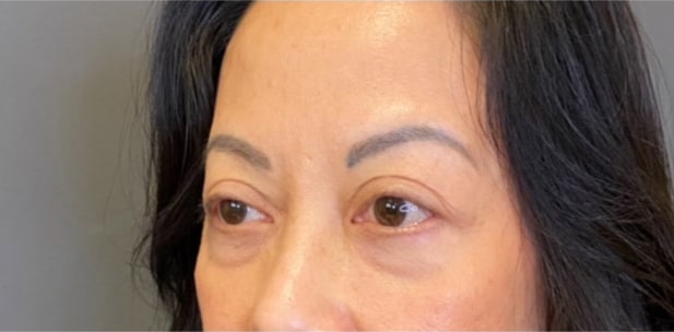 Eyelid Tuck