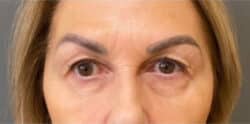 Eyelid Tuck