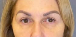 Eyelid Tuck