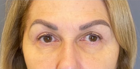 Eyelid Tuck