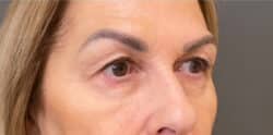 Eyelid Tuck