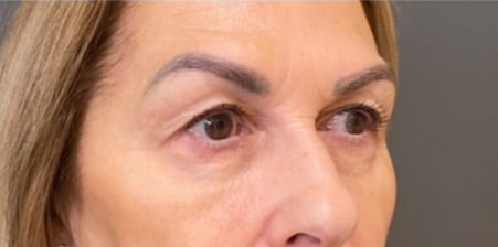Eyelid Tuck