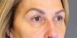 Eyelid Tuck