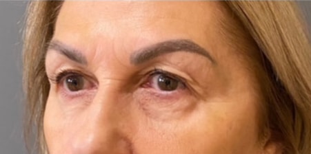Eyelid Tuck