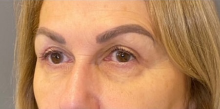 Eyelid Tuck