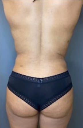 Liposuction