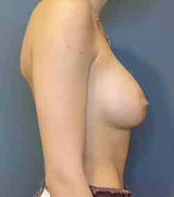 Breast Augmentation (Implants)