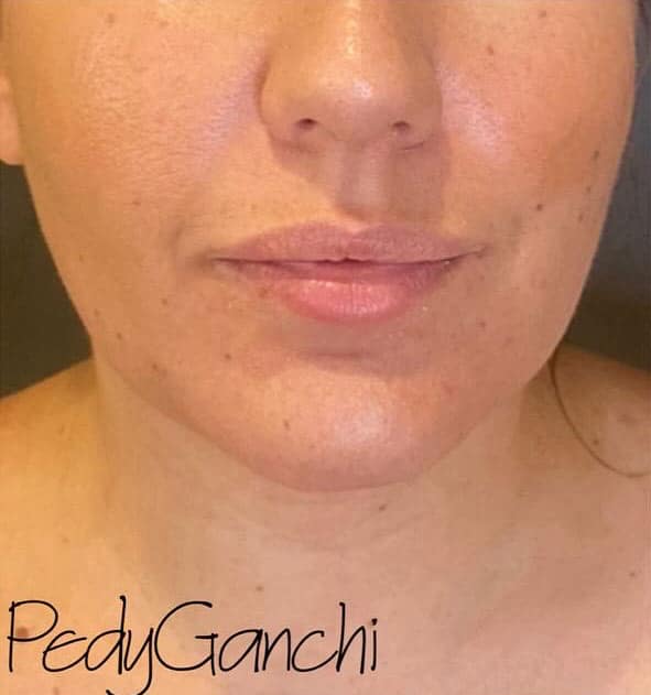 Chin Augmentation - Neck Liposuction