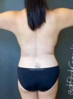 Breast Fat Grafting