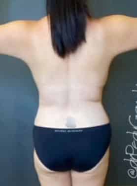 Breast Fat Grafting
