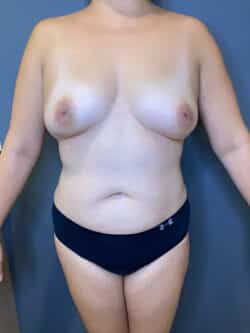 Breast Fat Grafting