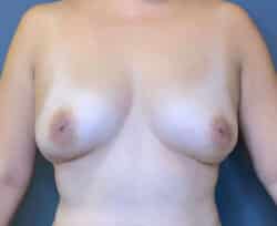 Breast Fat Grafting