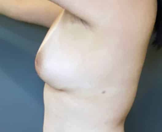 Breast Fat Grafting
