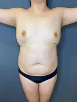 Breast Fat Grafting