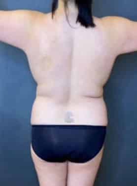 Breast Fat Grafting