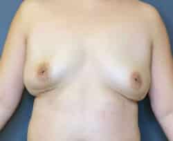 Breast Fat Grafting