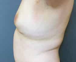 Breast Fat Grafting