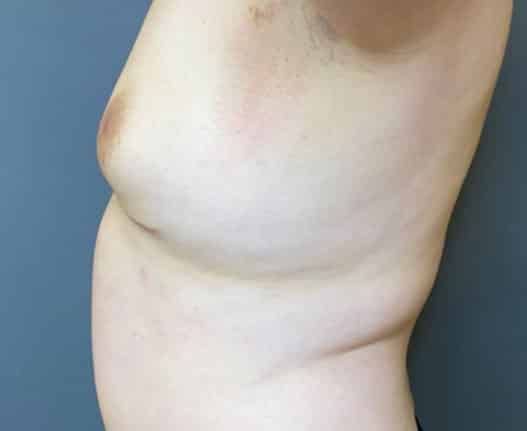 Breast Fat Grafting
