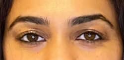 Eyelid Tuck