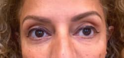Eyelid Tuck