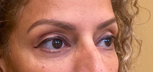 Eyelid Tuck
