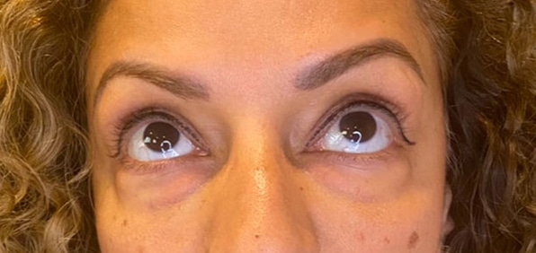 Eyelid Tuck