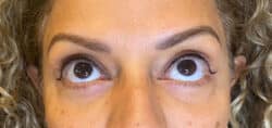 Eyelid Tuck