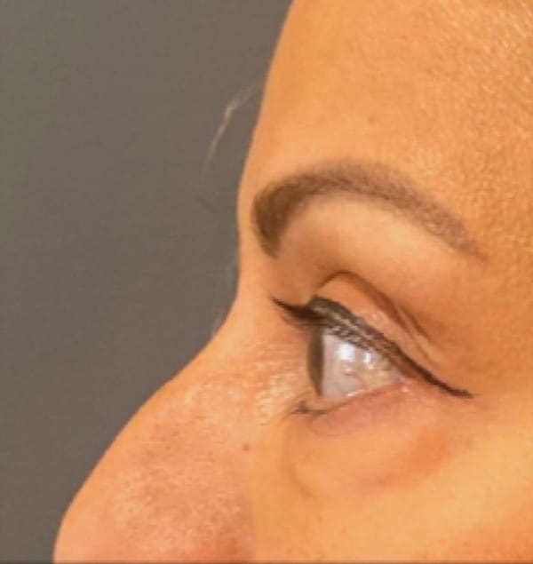 Eyelid Tuck
