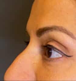 Eyelid Tuck