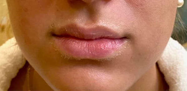 Fillers
