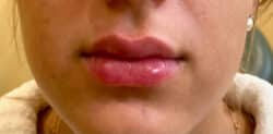 Fillers