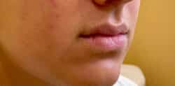 Fillers