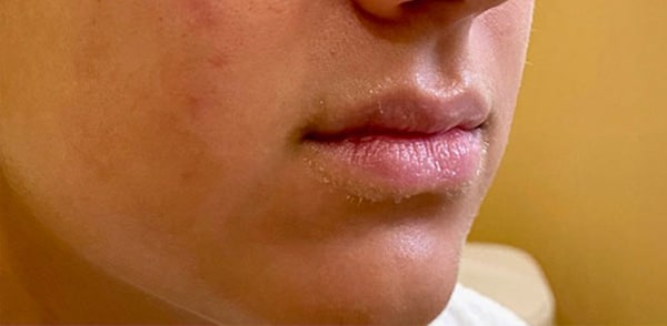 Fillers