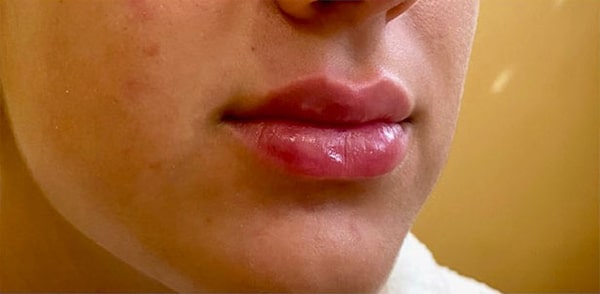 Fillers