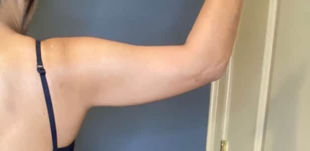 Liposuction