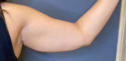 Liposuction