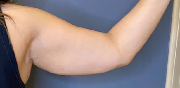 Liposuction