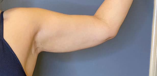 Liposuction