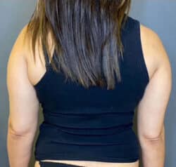 Liposuction