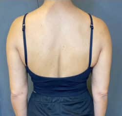 Liposuction