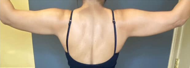 Liposuction