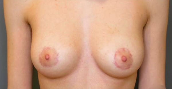 Breast Lift