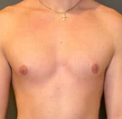 Gynecomastia (male breast reduction)