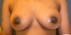 Nipple and Areola Surgery