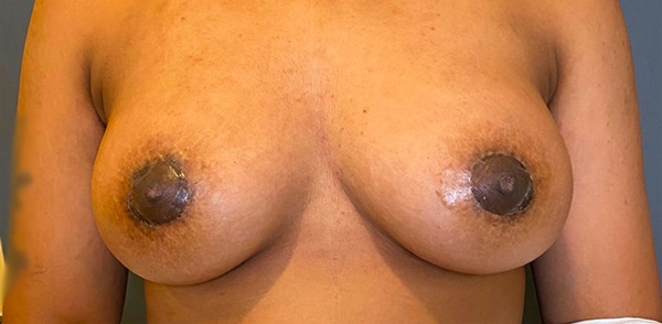 Nipple and Areola Surgery